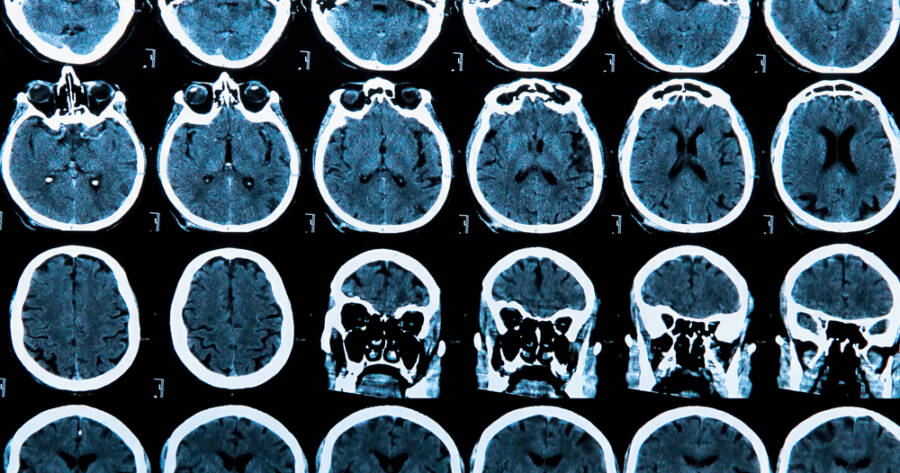 What Are the Key Aspects of Huntington’s Disease?